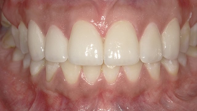 Close-up of bright white teeth and healthy pink gums in a perfect smile alignment.