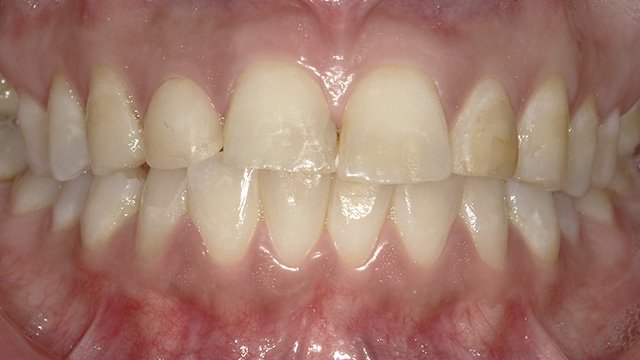 Close-up view of aligned upper and lower teeth showing proper dental occlusion and oral health.
