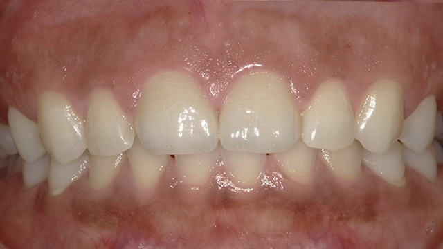 Close-up of front teeth showing dental work and gum health in clinical setting.