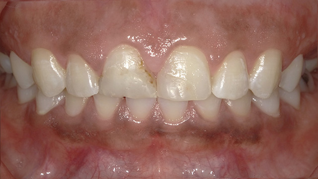 Upper front teeth display showing white dental crowns and natural tooth alignment in clinical setting.