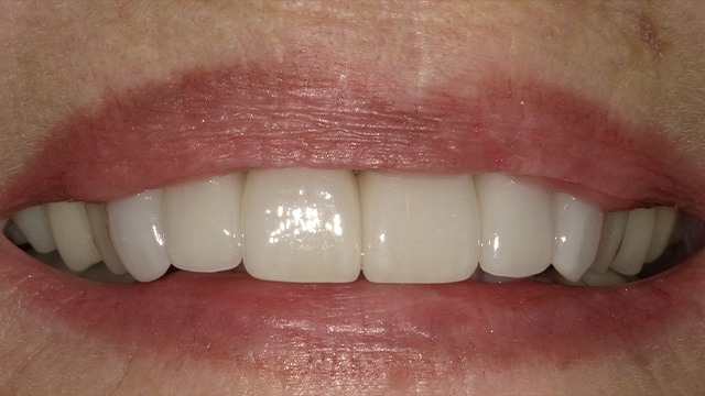 Close-up of a person's smile displaying white dental veneers and natural teeth alignment.