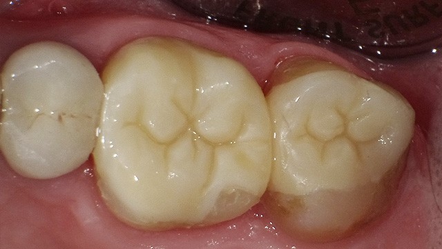 Close-up view of dental crowns and tooth restorations on upper molars in mouth.
