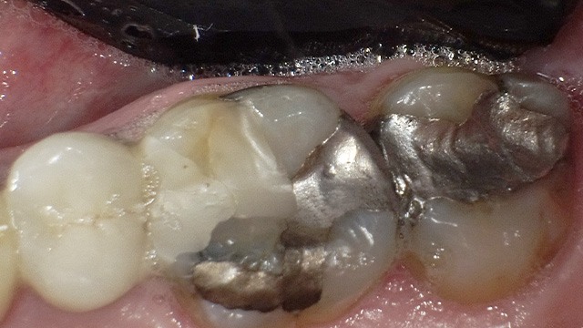 Close-up dental view showing tooth restoration and gum tissue during oral examination.