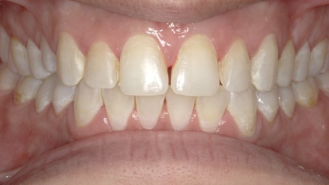 Close-up view of aligned upper and lower teeth showing dental health and proper bite alignment.