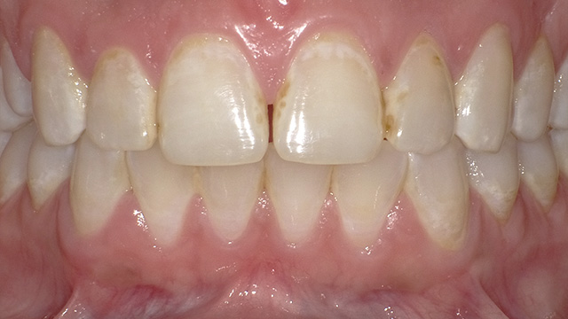 Close-up dental view showing upper and lower teeth with pink gums in clinical setting.