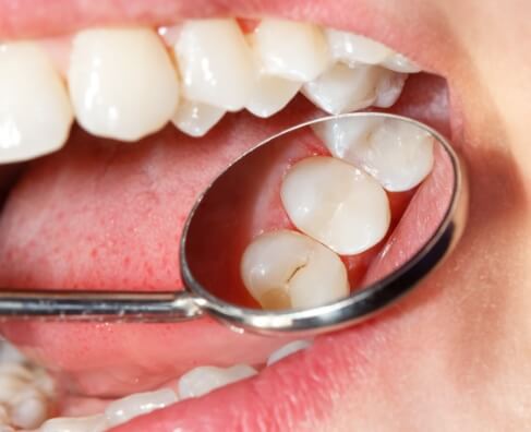 Dental mirror examining lower teeth and gums during oral health checkup