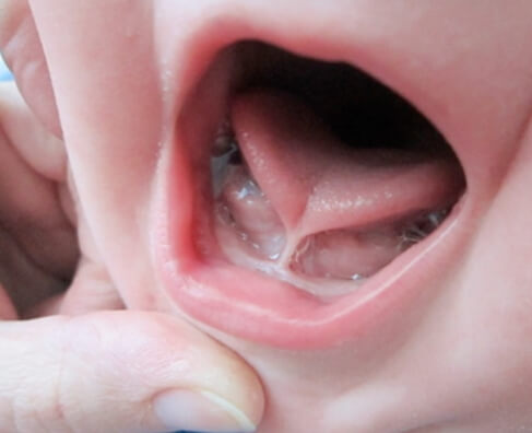 Close-up of child's open mouth showing interior oral cavity and teeth during dental examination.