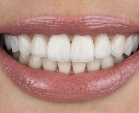 Close-up of a bright white smile showing healthy upper and lower teeth with pink lips.