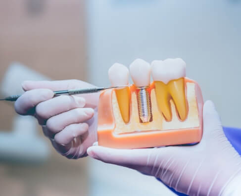 Dental implant process