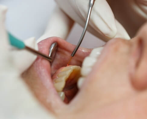 Dentist examining patient's teeth with dental mirror and suction tool during oral examination.