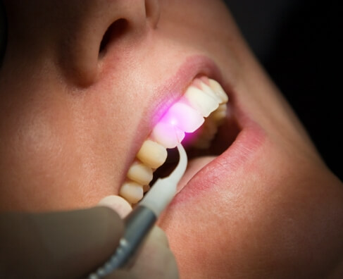 Dental patient receiving laser treatment on teeth during cosmetic dentistry procedure at Breezy Point Smiles.