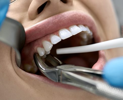 Dental professional performing tooth extraction procedure using surgical instruments on patient's mouth.