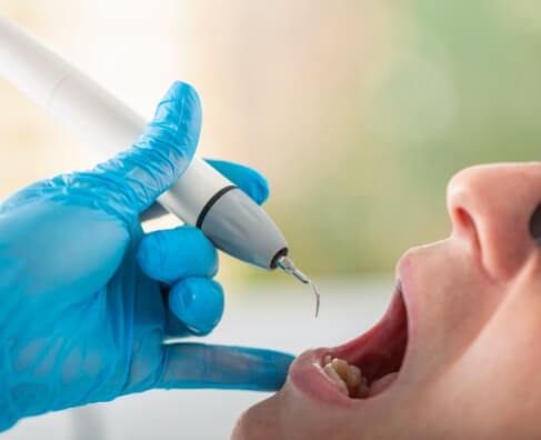 Periodontal Disease Treatment Queens