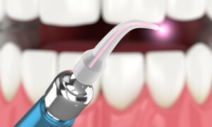 Dental laser tool performing gum treatment with bright pink light on patient's teeth and gums.