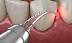 Dental scaler removing tartar from tooth surface during professional cleaning procedure.