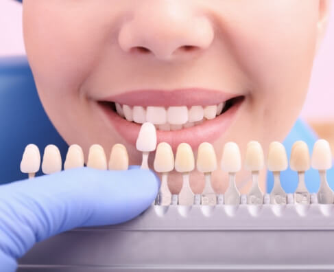 Dentist comparing tooth shade samples to patient's smile for cosmetic dental treatment.