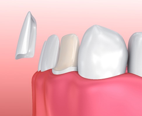 Dental crowns and tooth restoration visualization showing prosthetic tooth models on pink gum tissue background.