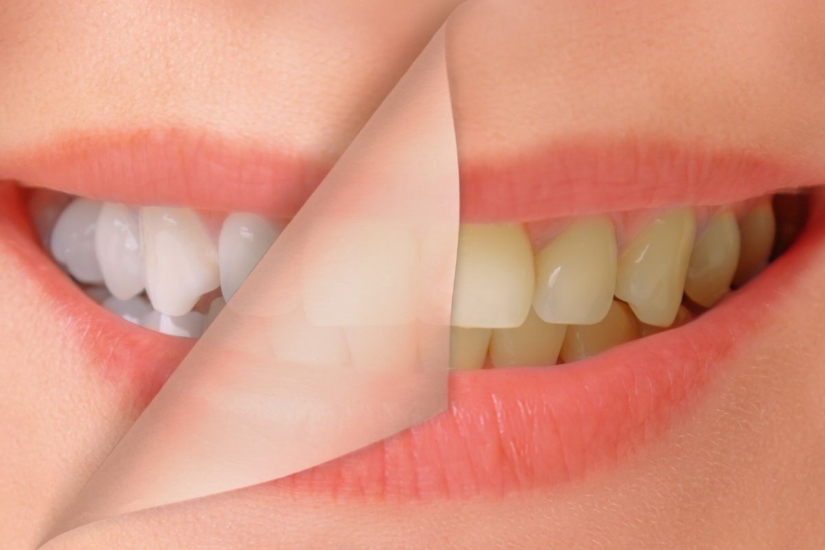 Teeth Whitening for Wedding Season
