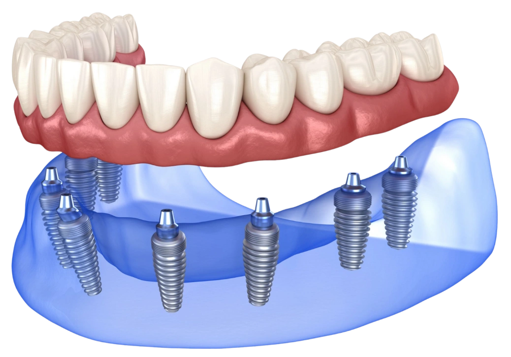 Dental implant prosthetic showing artificial teeth attached to titanium implants in jawbone model.