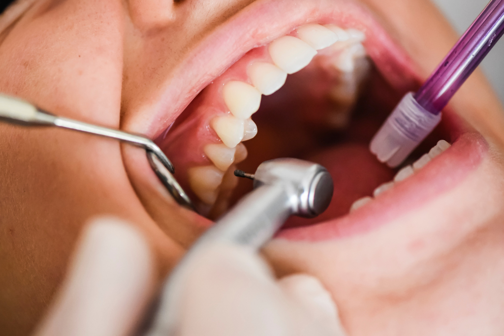 Close up of dental tool cleaning a patients teeth