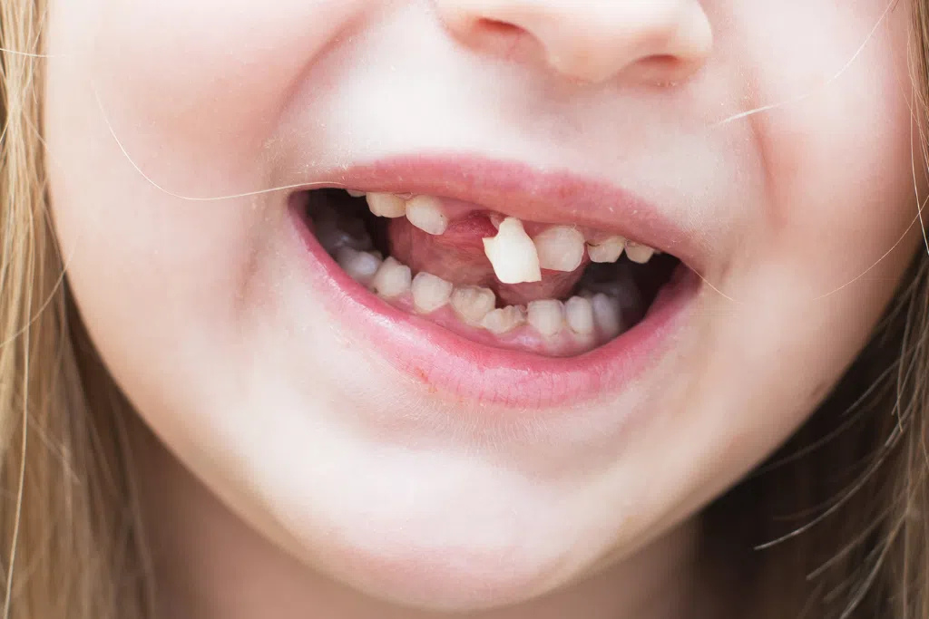 Close up of a child's mouth showing a missing tooth gap