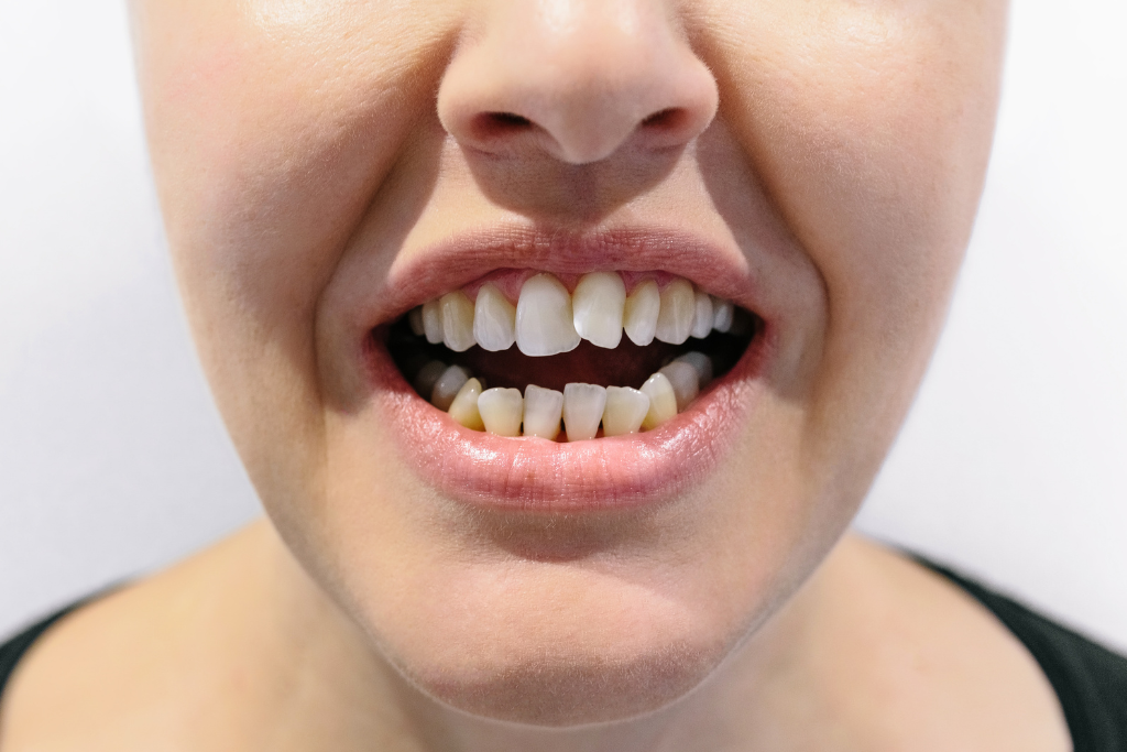 Closeup of a patient's uneven teeth