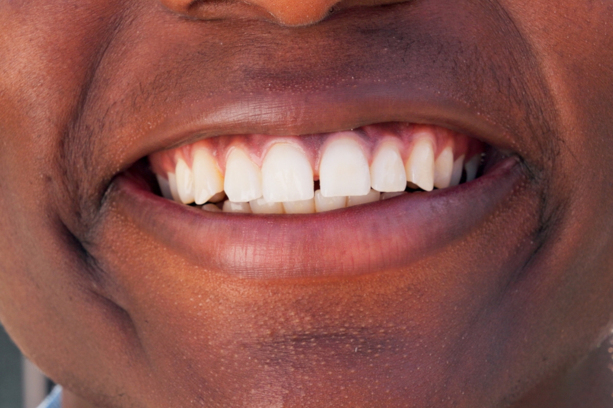 Person smiling with a visible gap between the upper front teeth
