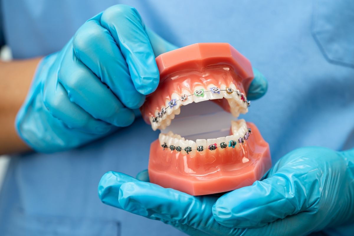 Orthodontist holding a dental model with braces to show crooked teeth treatment