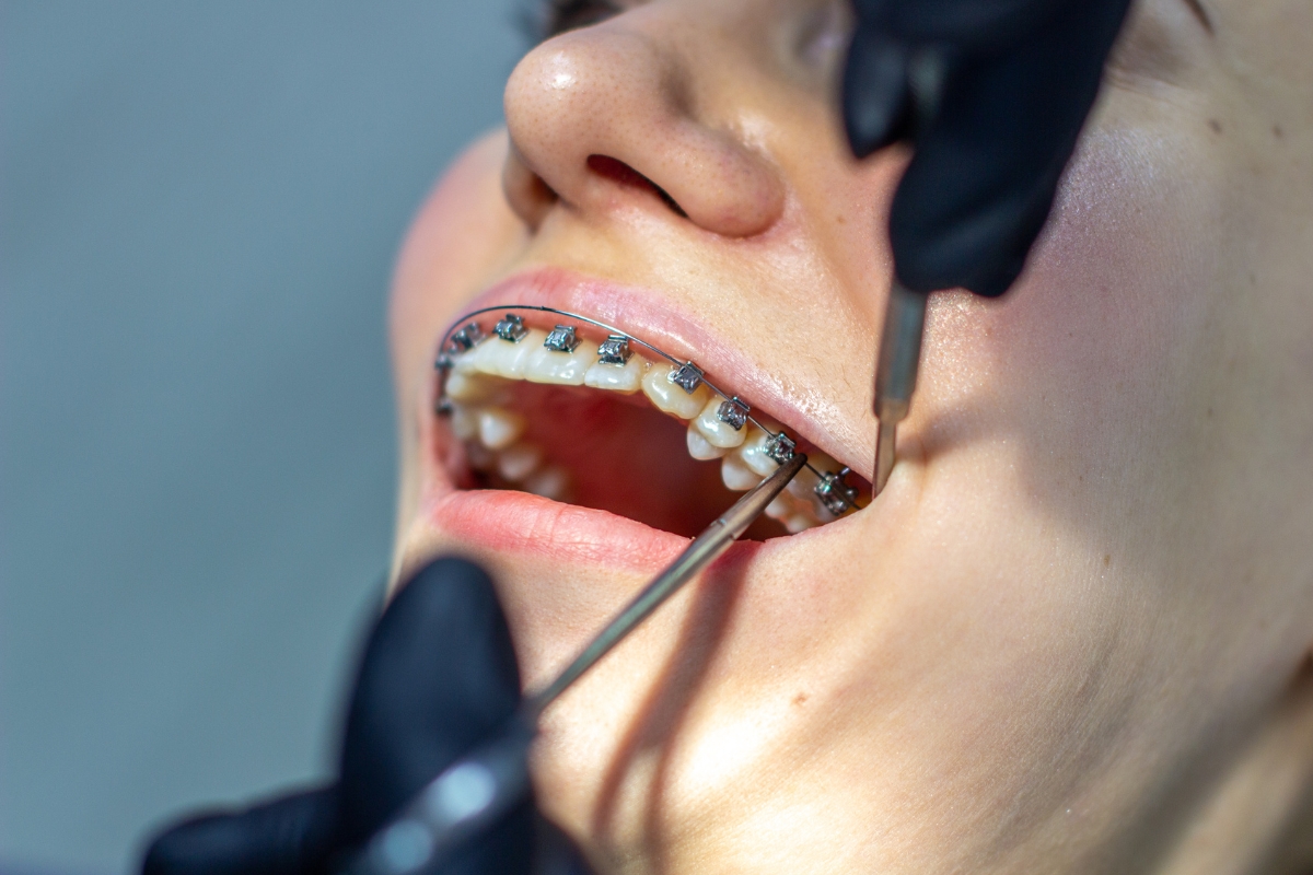 Orthodontist adjusts metal braces to correct bite problems in patient’s mouth